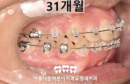 수술후