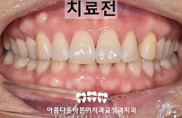 수술전