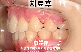 수술후