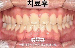 수술후