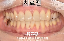 수술전