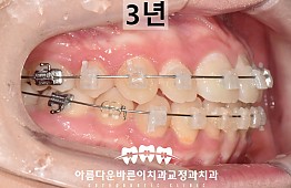 수술후