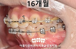 수술후