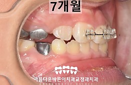 수술후