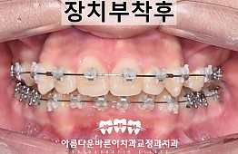 수술후