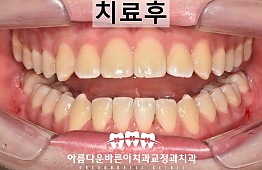 수술후