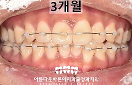 수술후