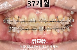 수술후
