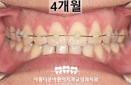 수술후