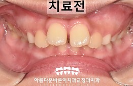 수술전