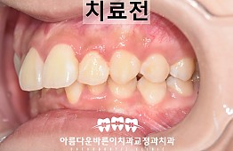 수술전