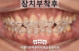 수술후