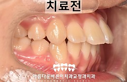 수술전