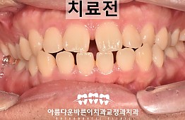 수술전