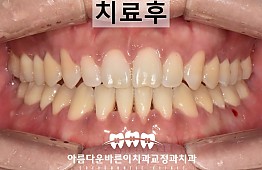 수술후