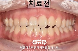 수술전