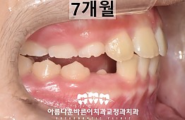 수술후