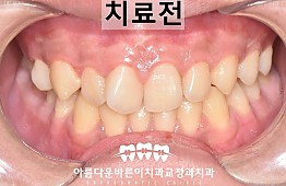 수술전