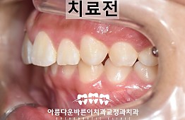 수술전