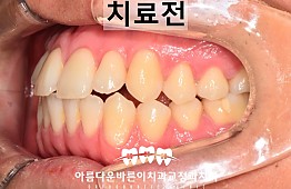 수술전