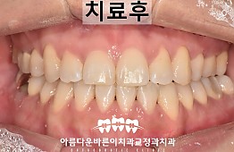 수술후