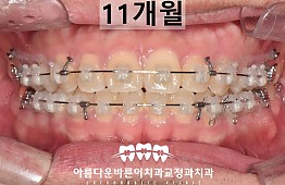 수술후