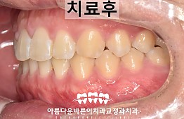 수술후