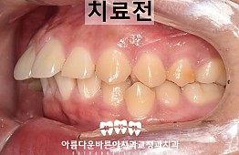 수술전