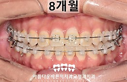 수술후