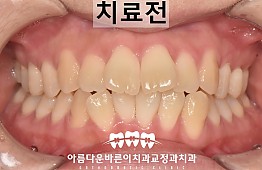 수술전