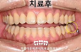 수술후