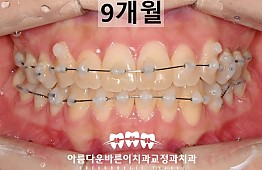 수술후