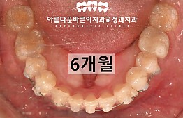 수술후