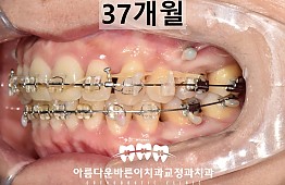 수술후