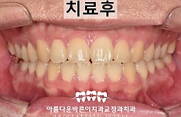 수술후