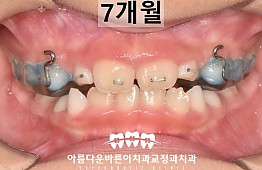 수술후