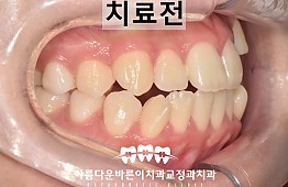 수술전