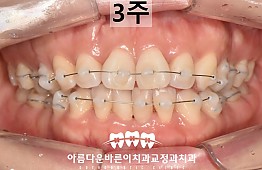 수술후