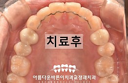 수술후