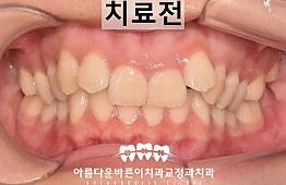 수술전