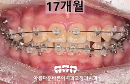 수술후