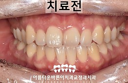 수술전