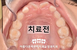 수술전