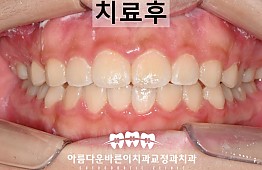 수술후