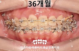 수술후