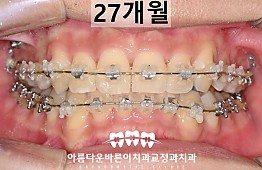 수술후