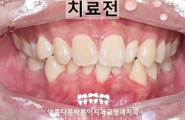 수술전