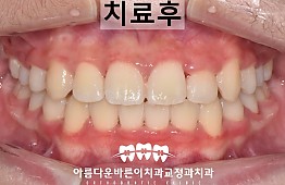 수술후