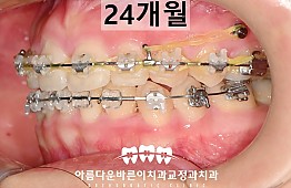 수술후