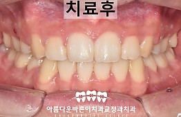 수술후